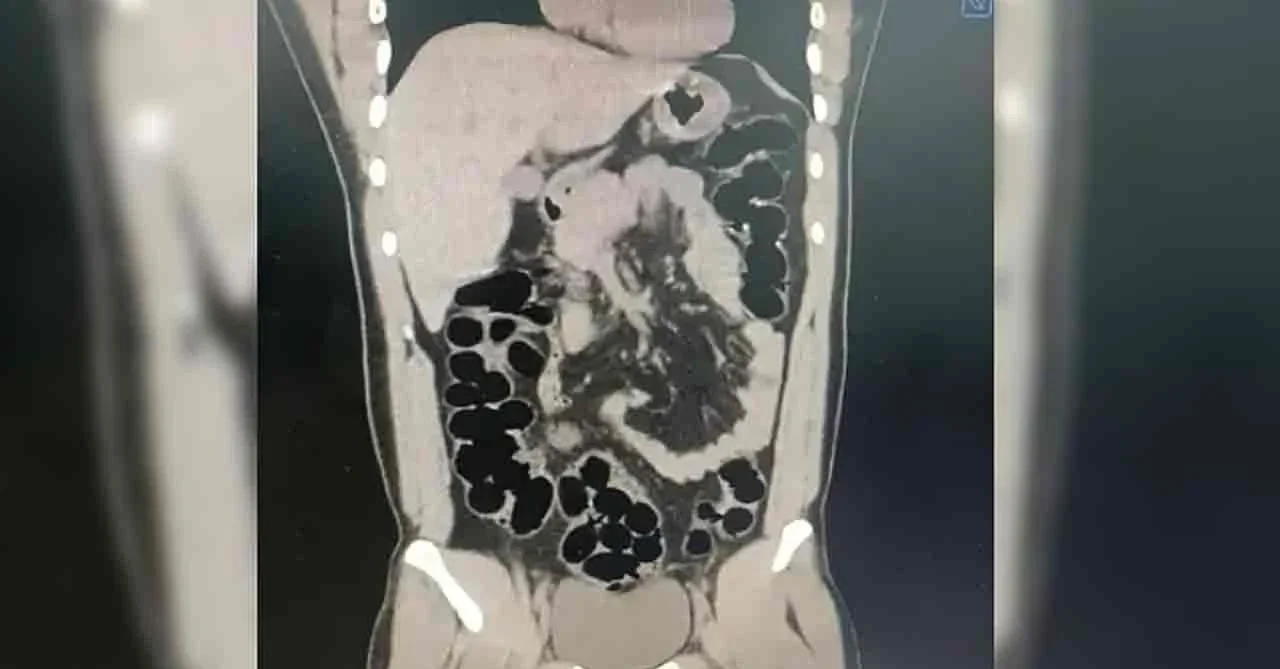 Bolu’da midesinde 89 kapsülle 943 gram eroin taşıyan şüpheli tutuklandı